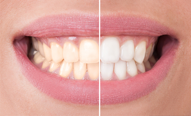 Zahnarzt Maintal, Zahnarztpraxis Maintal, Zahnästhetische Behandlung 